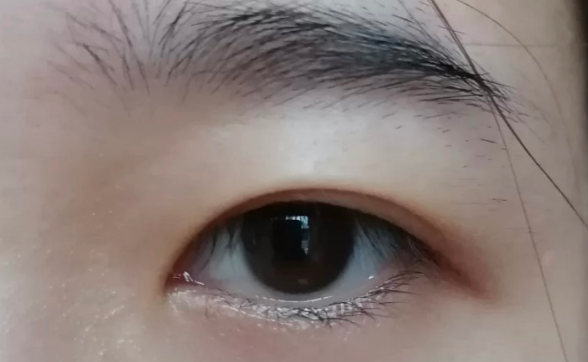 雙眼皮全切好還是韓式三點微創(chuàng)好？