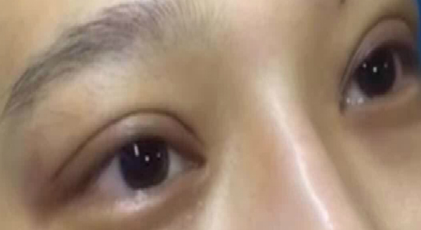 埋線雙眼皮大概能保持幾年？