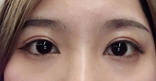 埋線雙眼皮幾天可以碰水？埋線雙眼皮有哪些注意事項？