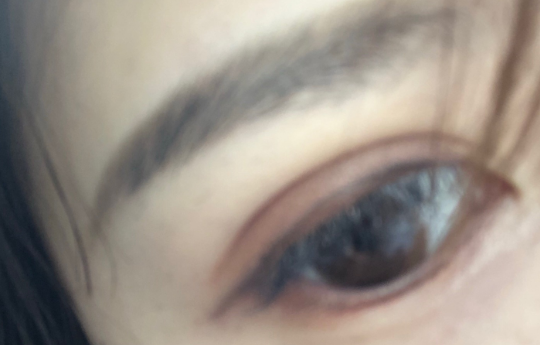 埋線(xiàn)雙眼皮手術(shù)優(yōu)勢(shì)有哪些？