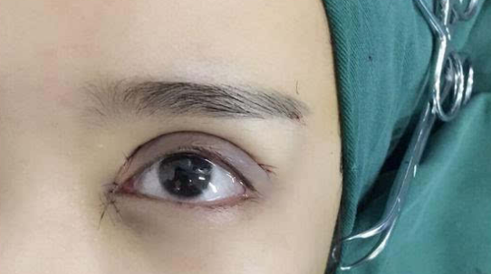 埋線雙眼皮會不會脫線？