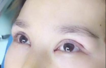 埋線雙眼皮有哪些注意事項(xiàng)？