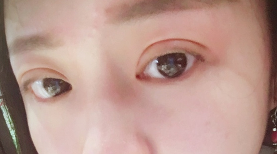 埋線雙眼皮可以保持幾年？埋線雙眼皮的危害有哪些？