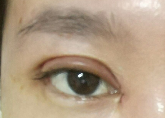 埋線(xiàn)雙眼皮可以維持幾年？