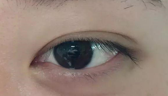 埋線雙眼皮有沒有危害？