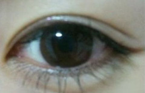 雙眼皮埋線怎么消腫快？埋線雙眼皮手術(shù)后有禁忌嗎？