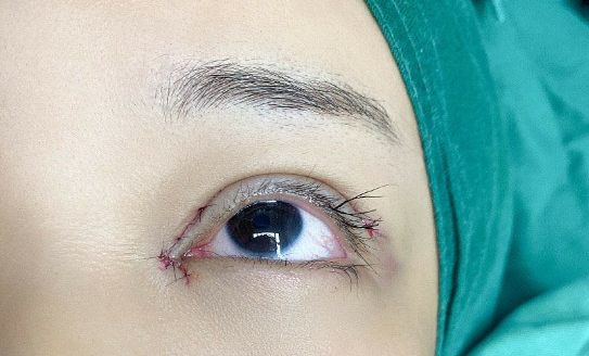 埋線雙眼皮消失怎么辦？
