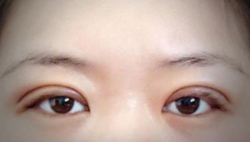 定點雙眼皮幾天能恢復好？定點做雙眼皮多少錢？