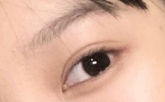 什么是雙眼皮定點(diǎn)？