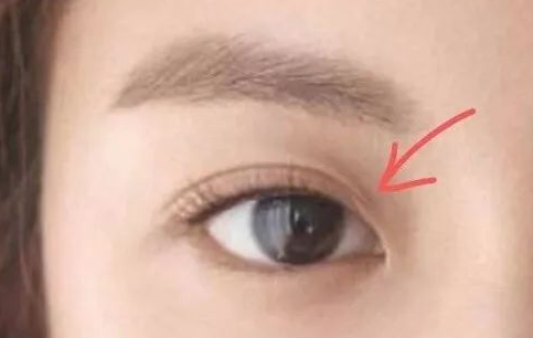 定點(diǎn)雙眼皮多久可以化妝？定點(diǎn)雙眼皮一般多少錢？