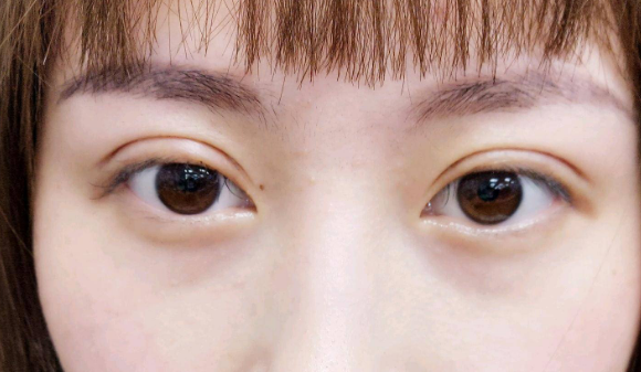定點(diǎn)雙眼皮是什么意思？雙眼皮定點(diǎn)能維持多久？