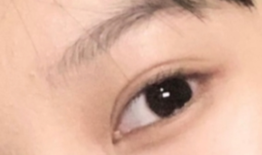 定點(diǎn)雙眼皮疼嗎？定點(diǎn)雙眼皮做完要多久時(shí)間？