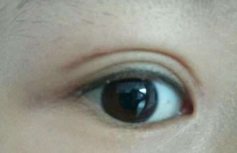 定點雙眼皮是怎么做的？