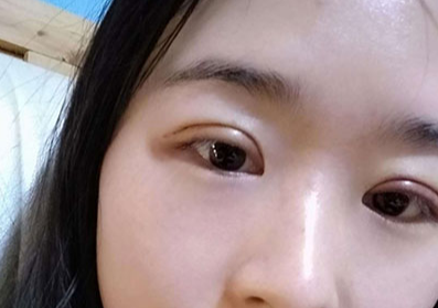 割雙眼皮后要冰敷多久？割雙眼皮后眼睛會變大嗎？