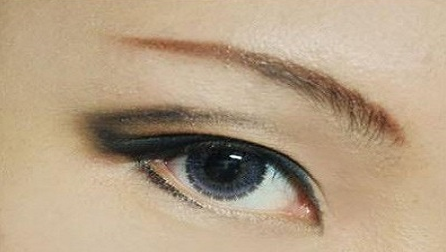 疤痕皮膚可以割雙眼皮嗎？