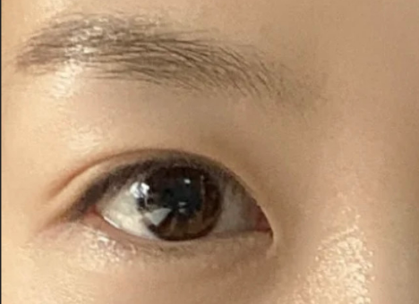 割雙眼皮后自然嗎？割雙眼皮后有危害嗎？