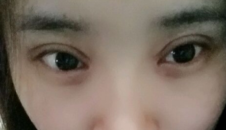 開眼角疼嗎？開眼角術(shù)后會(huì)留疤的原因有哪些？