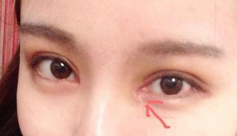 單眼皮開(kāi)內(nèi)眼角會(huì)留疤嗎？