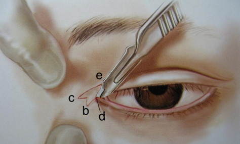 疤痕體質(zhì)可以割雙眼皮開眼角嗎？能一起做嗎