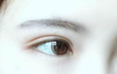 開眼角的恢復(fù)期多長？開眼角的后遺癥都有什么？