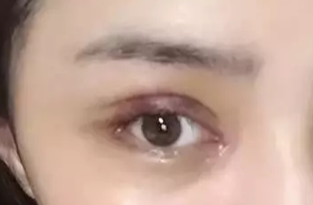 韓式開眼角失敗了怎么辦？