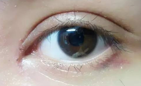 韓式開(kāi)眼角好嗎？韓式開(kāi)眼角術(shù)后怎么護(hù)理？