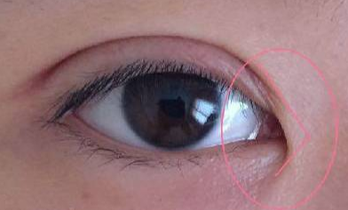 韓式開眼角恢復(fù)要多久？韓式開眼角術(shù)后有什么注意事項(xiàng)？