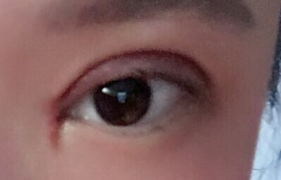 韓式開(kāi)眼角手術(shù)有哪些優(yōu)勢(shì)？