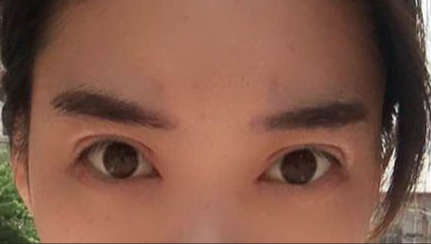 韓式開眼角的有副作用嗎？