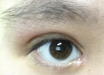 韓式開眼角的效果怎么樣？韓式開眼角失敗了怎么辦？