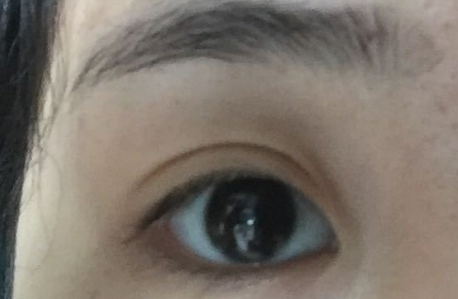 開內(nèi)眼角拆線后變化明顯嗎？開內(nèi)眼角會(huì)不會(huì)留疤？