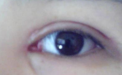 開外眼角拆線疼嗎？