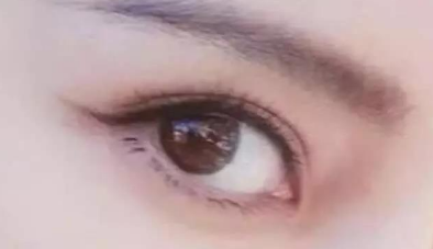 開內眼角會讓你眼睛變大嗎？