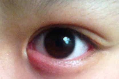 開(kāi)內(nèi)外眼角的缺點(diǎn)有哪些？