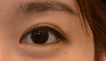 開個外眼角手術有多大風險？