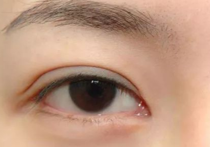 開(kāi)內(nèi)外眼角多久能恢復(fù)好？開(kāi)內(nèi)外眼角多少錢(qián)？