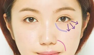 開內(nèi)外眼角的效果如何？開內(nèi)外眼角的缺點(diǎn)？