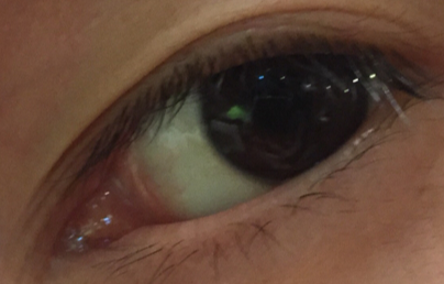 開眼角大概多少錢？