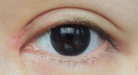 開(kāi)眼角術(shù)后如何護(hù)理？