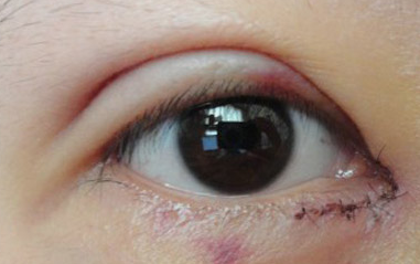 開內(nèi)眼角過程中會疼嗎？開內(nèi)眼角的風(fēng)險有哪些？