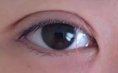 開(kāi)內(nèi)眼角的作用有哪些？