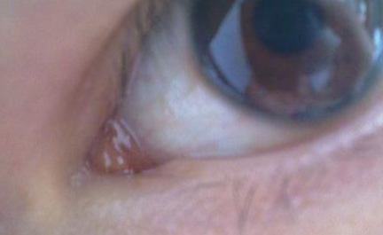 開內(nèi)外眼角需要注意什么？