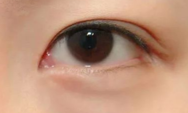 開(kāi)內(nèi)眼角的優(yōu)缺點(diǎn)有哪些？