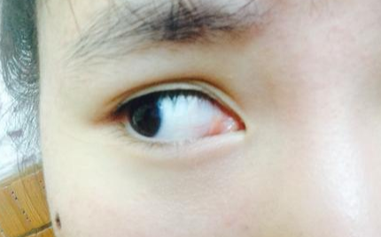 開內(nèi)眼角多久可以回縮？開內(nèi)眼角多久能消腫？