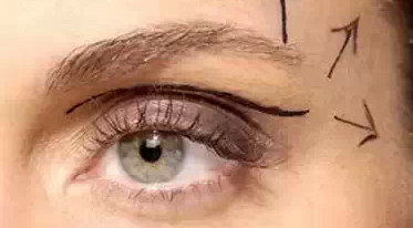 開(kāi)內(nèi)外眼角需要幾次？