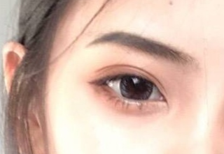 開(kāi)內(nèi)外眼角怎么消腫快？開(kāi)內(nèi)外眼角有什么壞處？