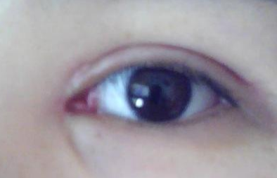 開(kāi)內(nèi)外眼角效果怎么樣？開(kāi)內(nèi)外眼角需要多長(zhǎng)時(shí)間？