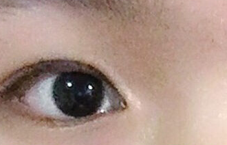 開(kāi)內(nèi)眼角的危害有哪些？