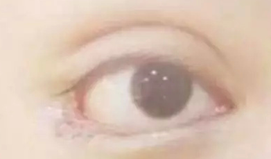 開內(nèi)眼角的效果好嗎？