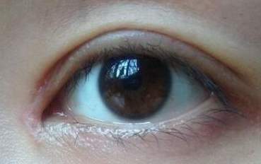 開內(nèi)眼角的禁忌癥是什么？